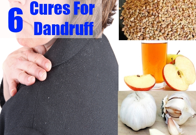 Cures For Dandruff