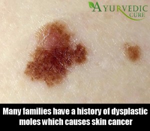 Top 7 Causes And Reasons Of Moles | AyurvedicCure.com