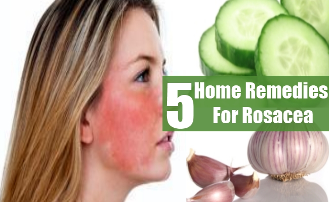 Top 5 Home Remedies For Rosacea - Natural Treatments And Cures | Herbal ...