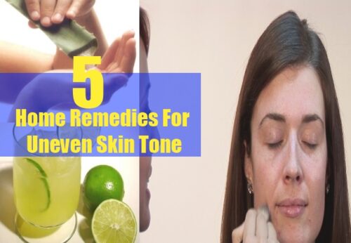 Amazing Home Remedies For Uneven Skin Tone - Natural Treatments For ...