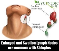 Five Common Signs & Symptoms Of Shingles | AyurvedicCure.com