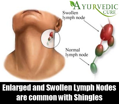 Lymph Nodes