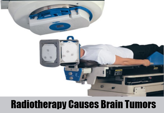 Radiotherapy Can Cause Brain Tumors