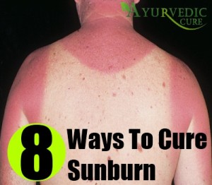 treating second degree sunburn