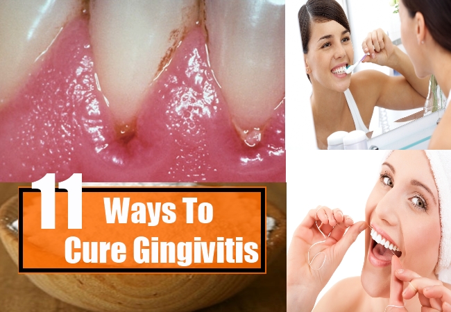 Ways To Cure Gingivitis