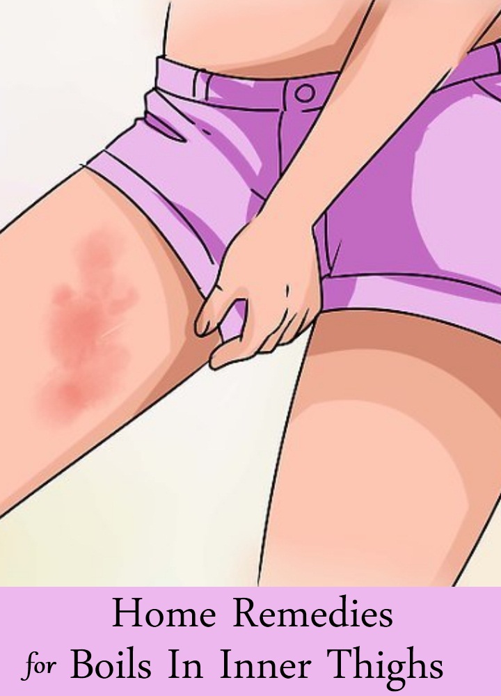 Home Remedies For Boils In Inner Thighs